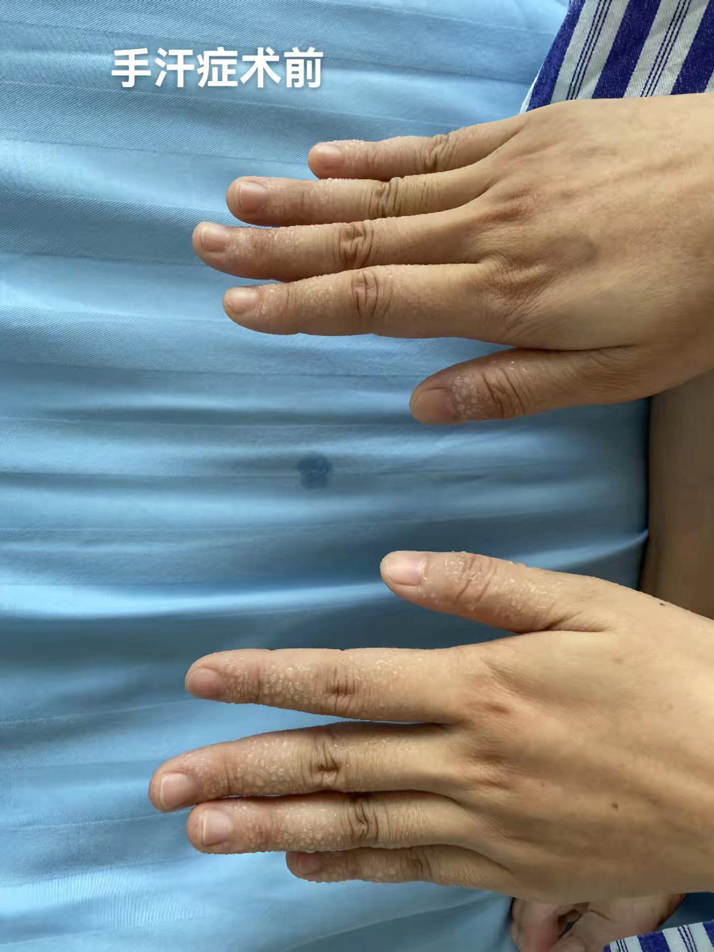 手汗症……天天科普肺癌相关知识，其实手汗症也是属于胸外科疾病范畴。 手...