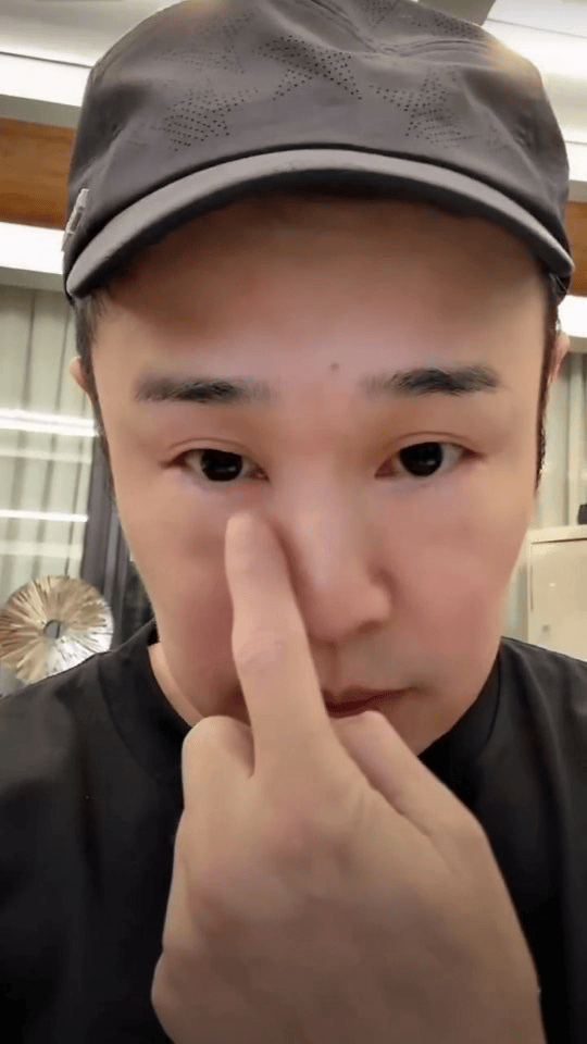 小沈阳直播小沈阳肿成蜜蜂小狗了哈哈一觉睡醒眼睛肿成蜜蜂小狗😂晚上还有两个公演舞