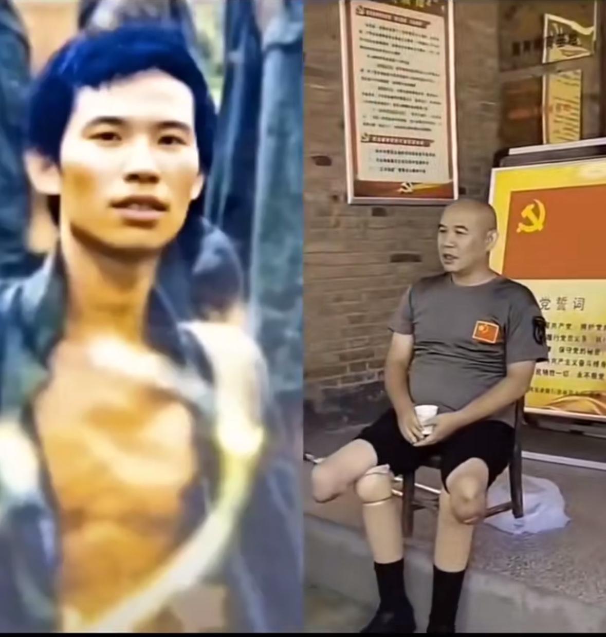 老山班长李土强，陕西省西安人，双腿被炸断仍不下火线，遭截肢。1985年12月，随