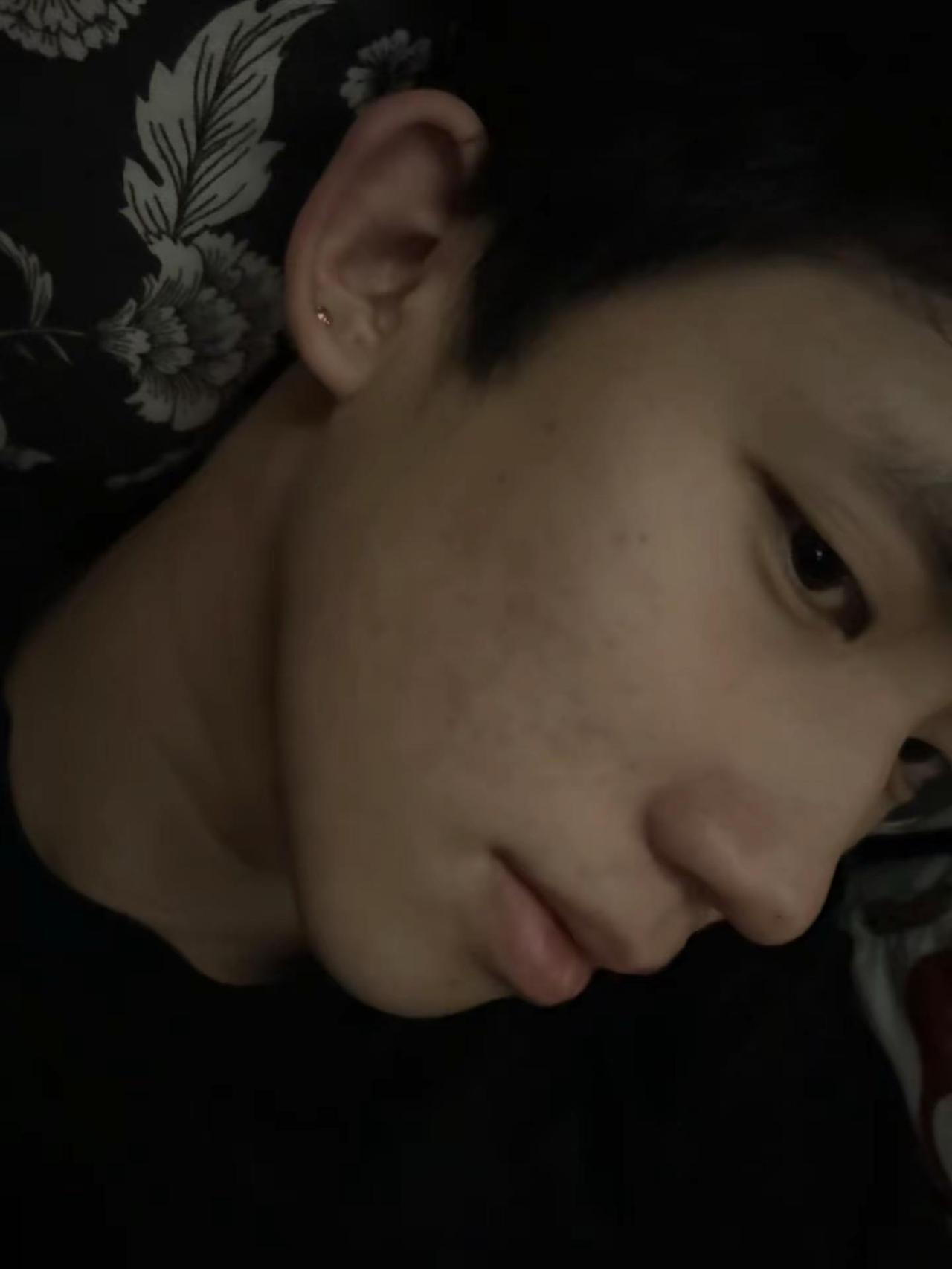 皮肤快好了低鼻梁男生