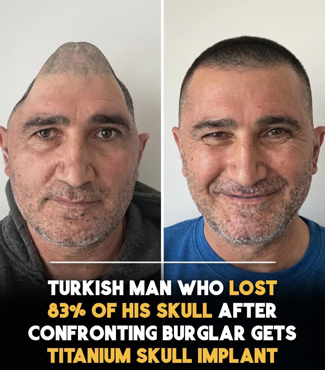 土耳其伊斯坦布尔男子Ali Ciftci在家抵御入室窃贼时，颅骨遭受灾难性损伤。
