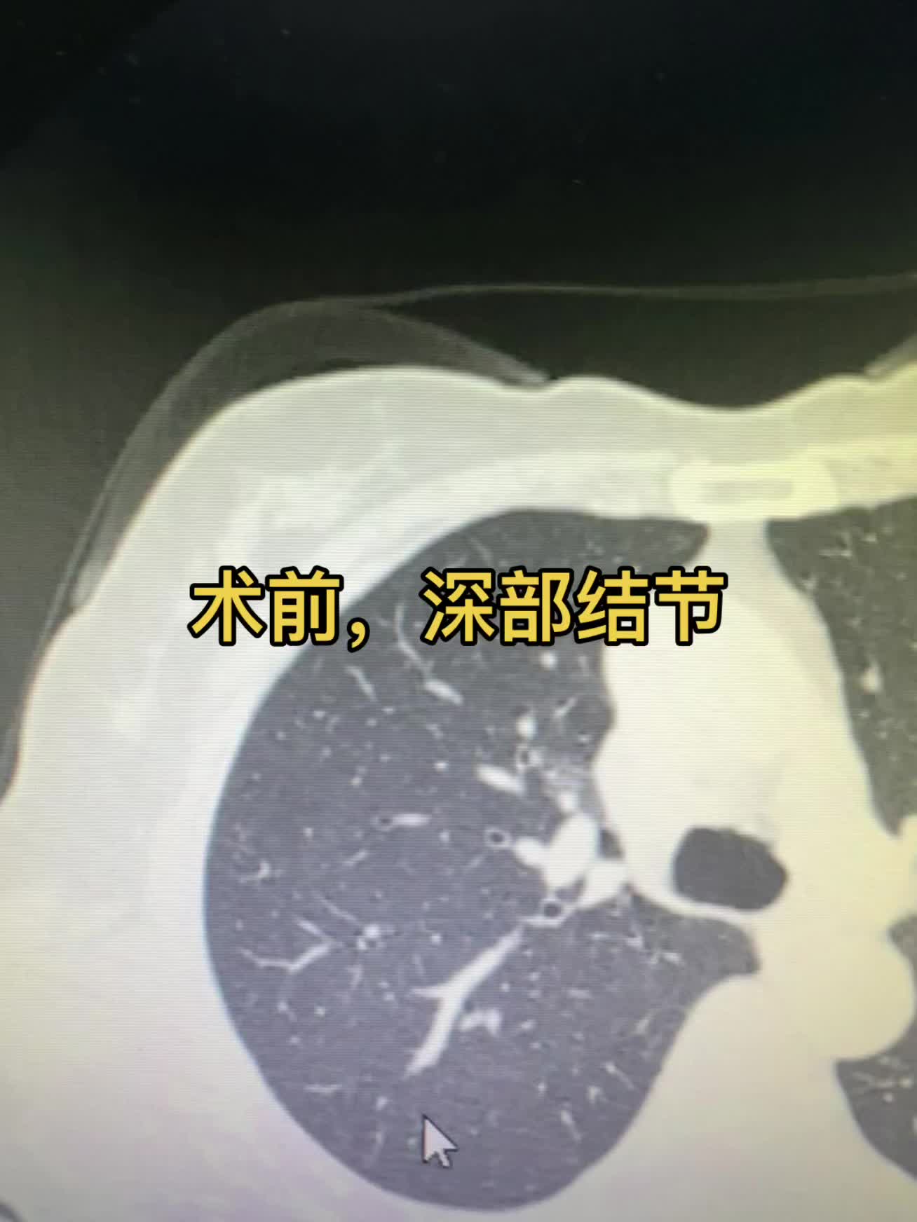 深不结节的楔形切除 有术后CT为证