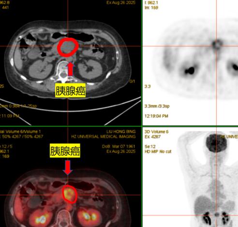 别再盲目节食了！19 岁女学霸省生活费少吃饭，确诊胰脏癌晚期，家人倾家荡产救她