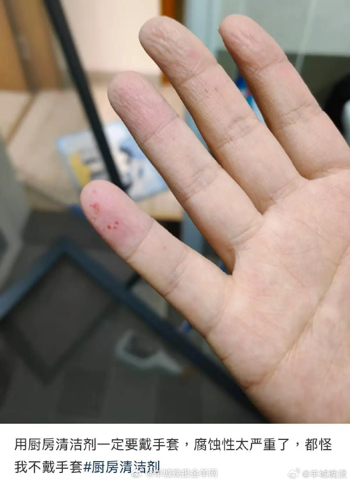 【#多名消费者称用清洁剂后手部被腐蚀#】#部分电商平台违规销售危险化学品#手指被