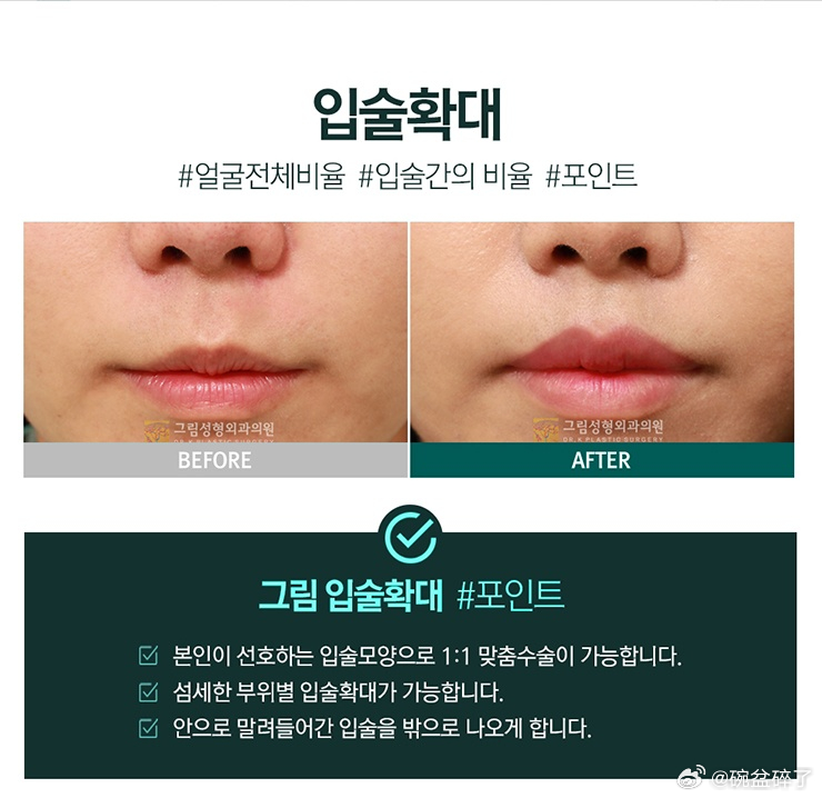 韩国目前常见的嘴唇扩大术主要分为两种方式。第一种是红唇前进术。简单来说，就是把原