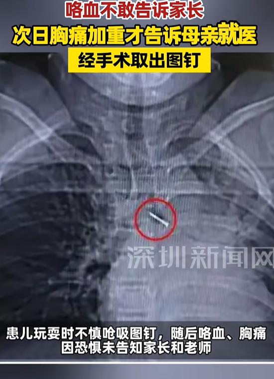 “太危险了！”10月23日报道，北京，一男孩不小心，把图钉吃下去，随后出现了咯血