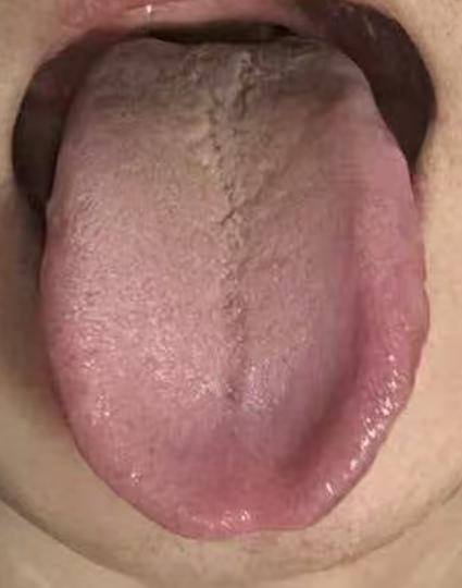 气血瘀阻致宗筋失养，调补通改善男性状态






来自浙江杭州的马先生，因为功