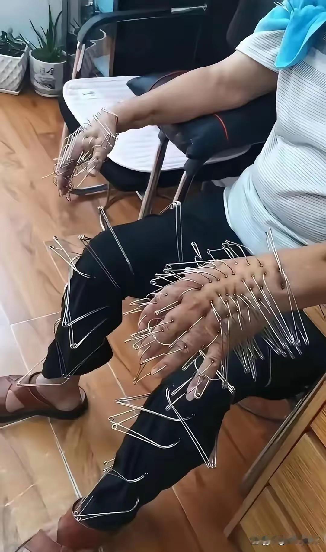 感觉这不是针灸，这像是一种精准穴位按摩，因为我曾经做过针灸，做针灸的针是比较细的