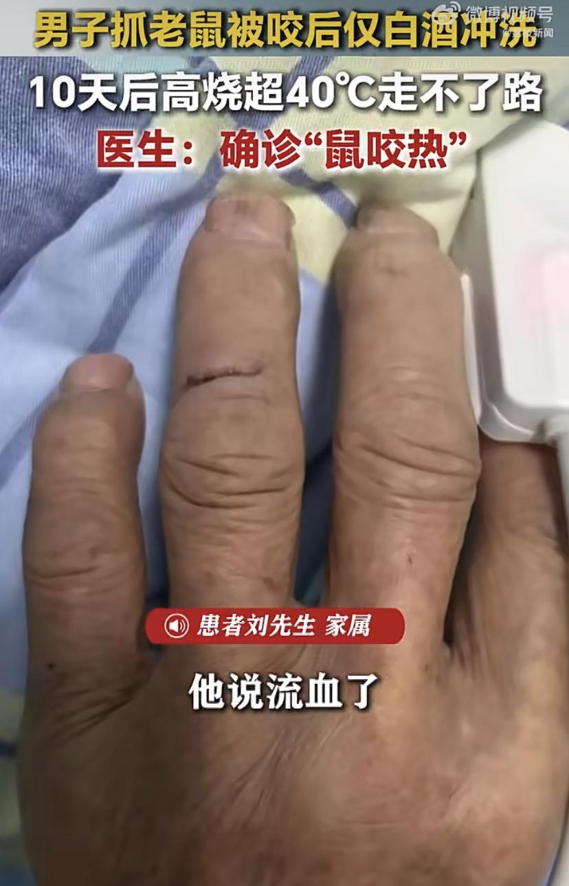 深圳一男子被老鼠咬了一口，差点要了命!
刘先生在宿舍抓粘鼠板上的老鼠，反被咬伤手