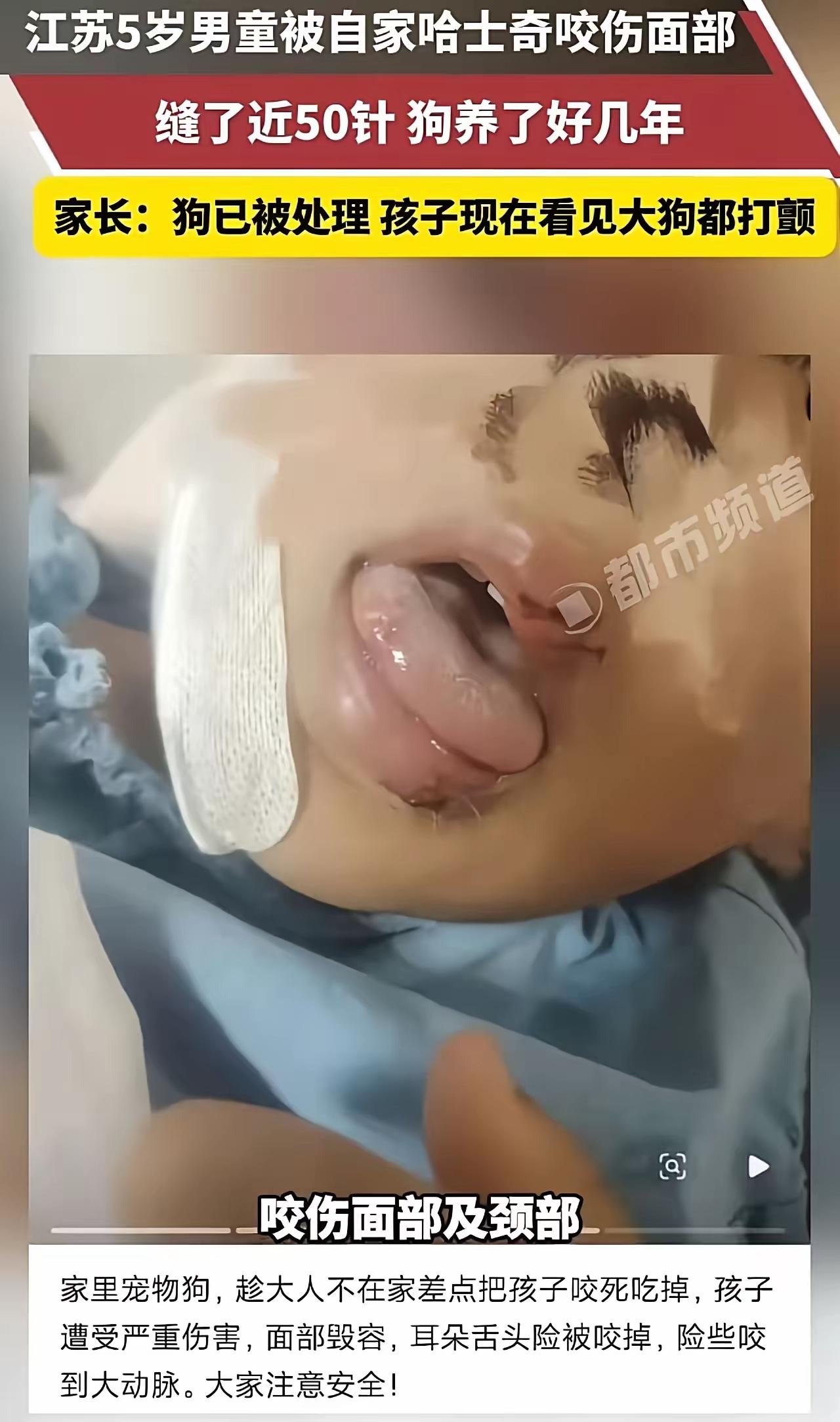 “这下养狗的都被干沉默了！”5月2日报道，江苏，5岁男童被自家哈士奇咬伤面部，缝