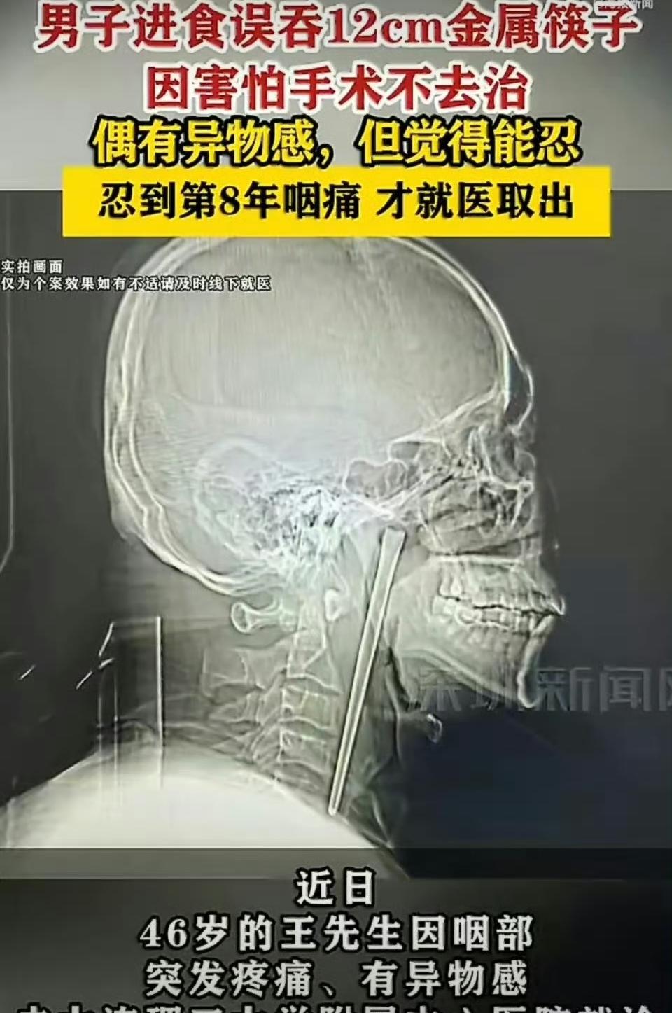 术后，王先生躺在病床上，回想起这8年的经历也是一阵后怕。他坦言，当初就是因为害怕