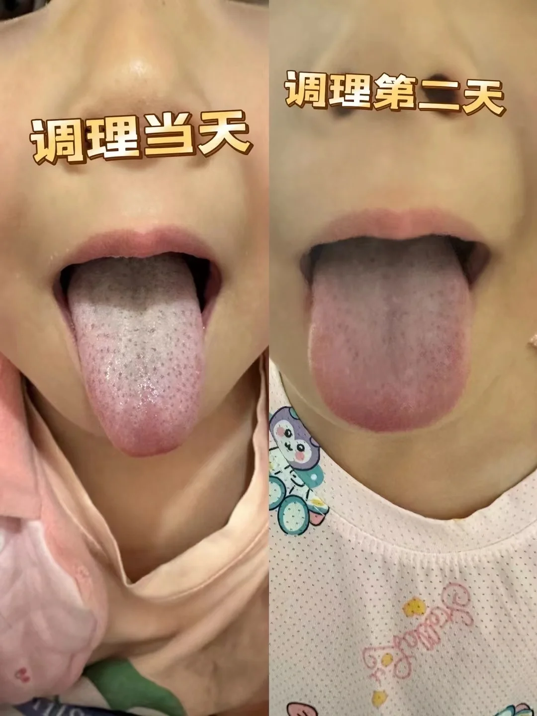 推拿的孩子始终推拿，跑医院的孩子始终跑医