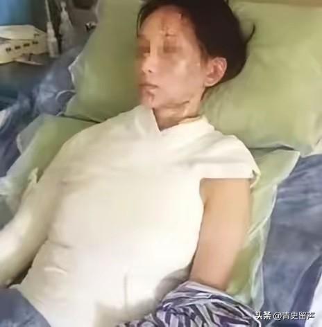 “这就是嘴欠的下场”！一盆滚烫高汤从头顶浇下，28岁温州姑娘林某的面容瞬间被高温