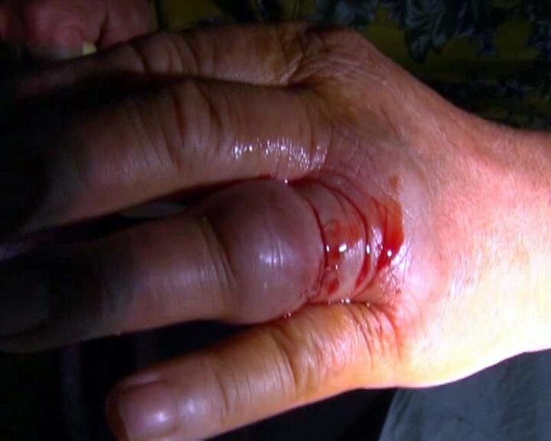 有人说小伤口不算事，抹点碘伏就好。但一位51岁的男子因手上划伤、即使接种疫苗仍不