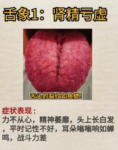 舌有深裂纹？可能是肾精亏虚，对照看看这些表现