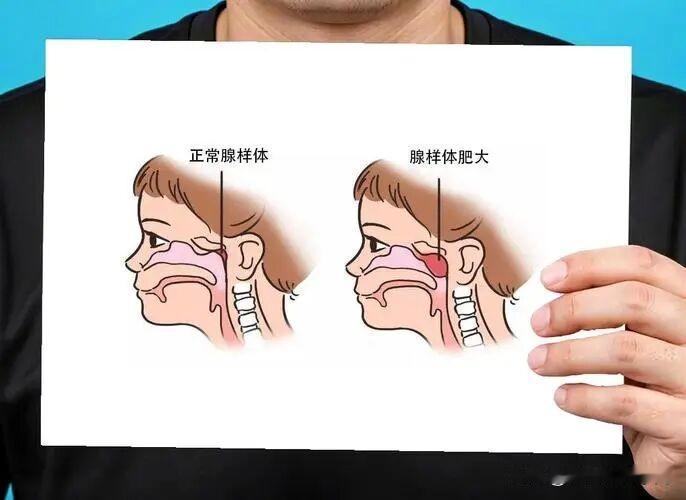 【腺样体肥大倒着治，怎么来的，还怎么让它走！】
门诊上，太多家长红着眼圈问我：“