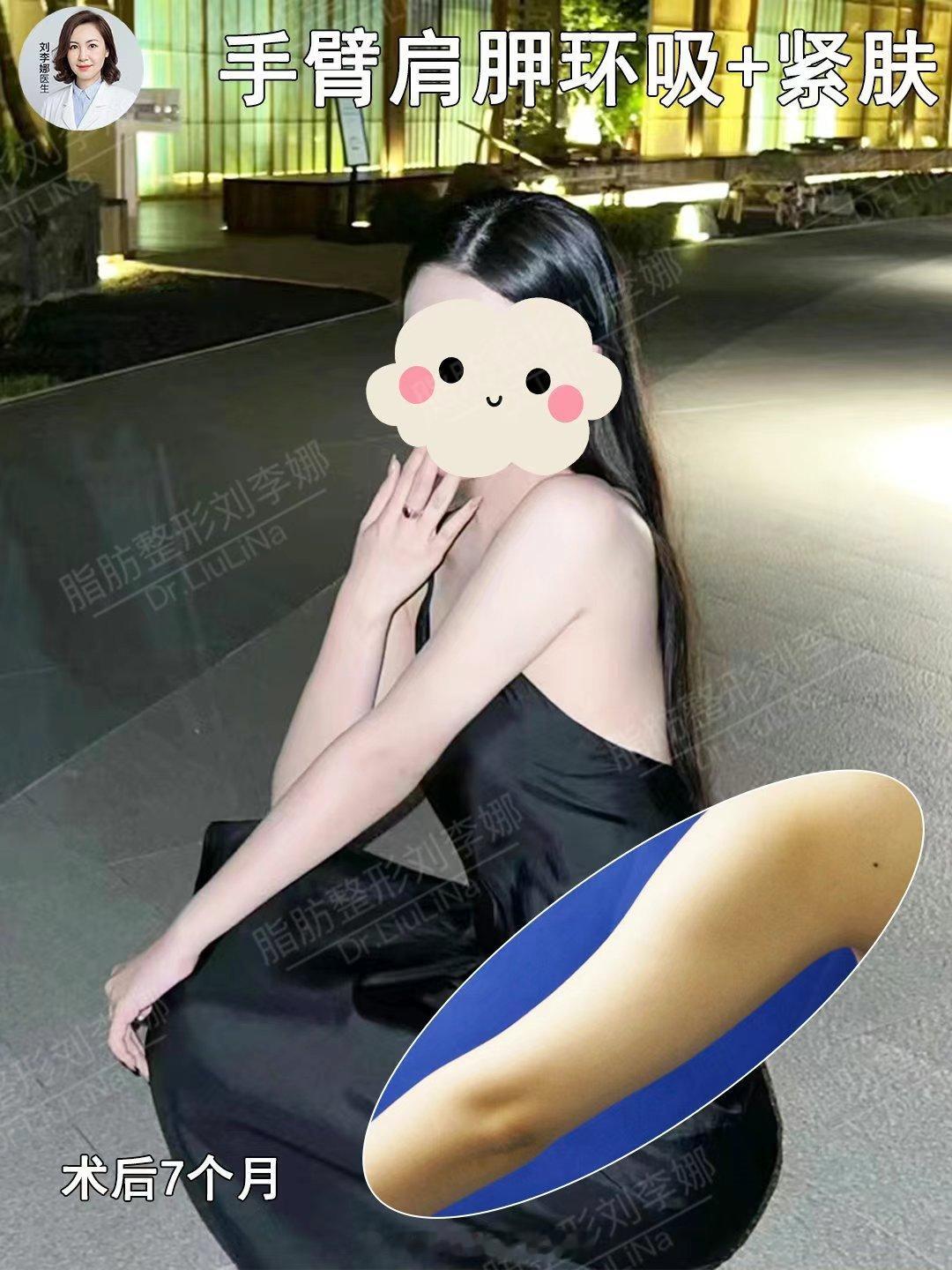 脂肪整形刘李娜手臂吸脂手臂抽脂 手臂环吸+肩胛吸脂+黄金微雕术后7个月，肩臂明显