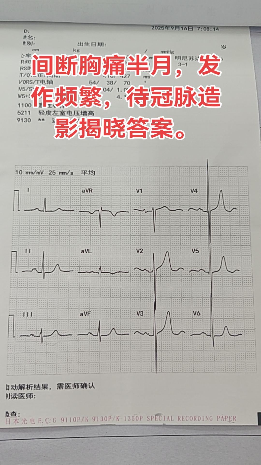 心电图与冠脉狭窄。