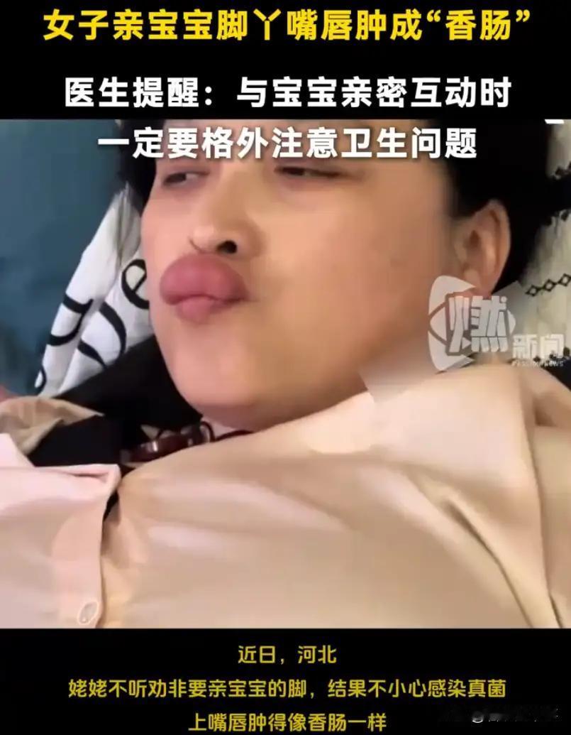 万万没想到，一个充满疼爱的亲吻，竟让外婆的嘴唇肿成了“香肠”。

近日，河北一位