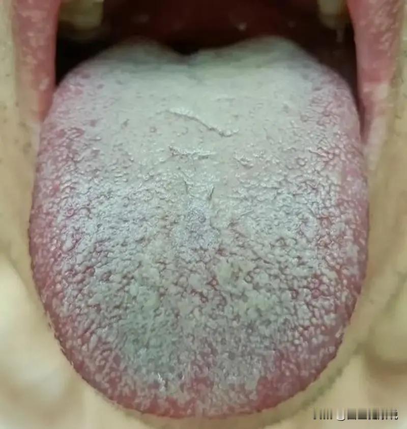 舌苔太腻，你去疏肝是疏不动的
伸出舌头看看自己的舌苔厚不厚腻，你要是厚腻啊，你补