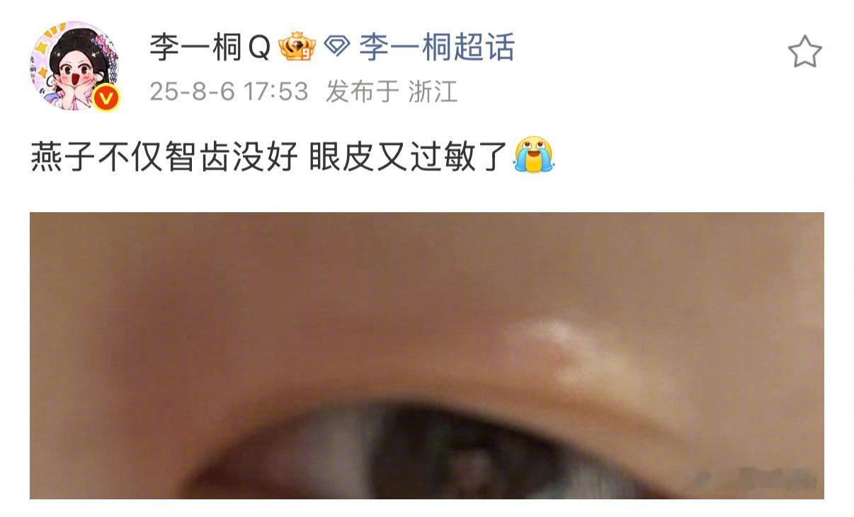 李一桐蜜蜂小狗预备役李一桐智齿没好眼皮又过敏了 近日，透露自己智齿没好眼皮又过敏