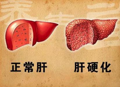 肝硬化患者日常生活中应该注意什么？
肝硬化患者在平时的日常生活中应该注意些什么呢