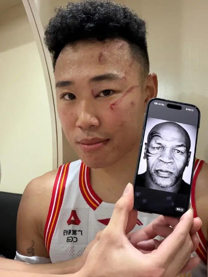 周琦和贺希宁的我愿意。贺希宁的脸堪比泰森。只是一个是被对手抓伤，一个是纹的。拿着