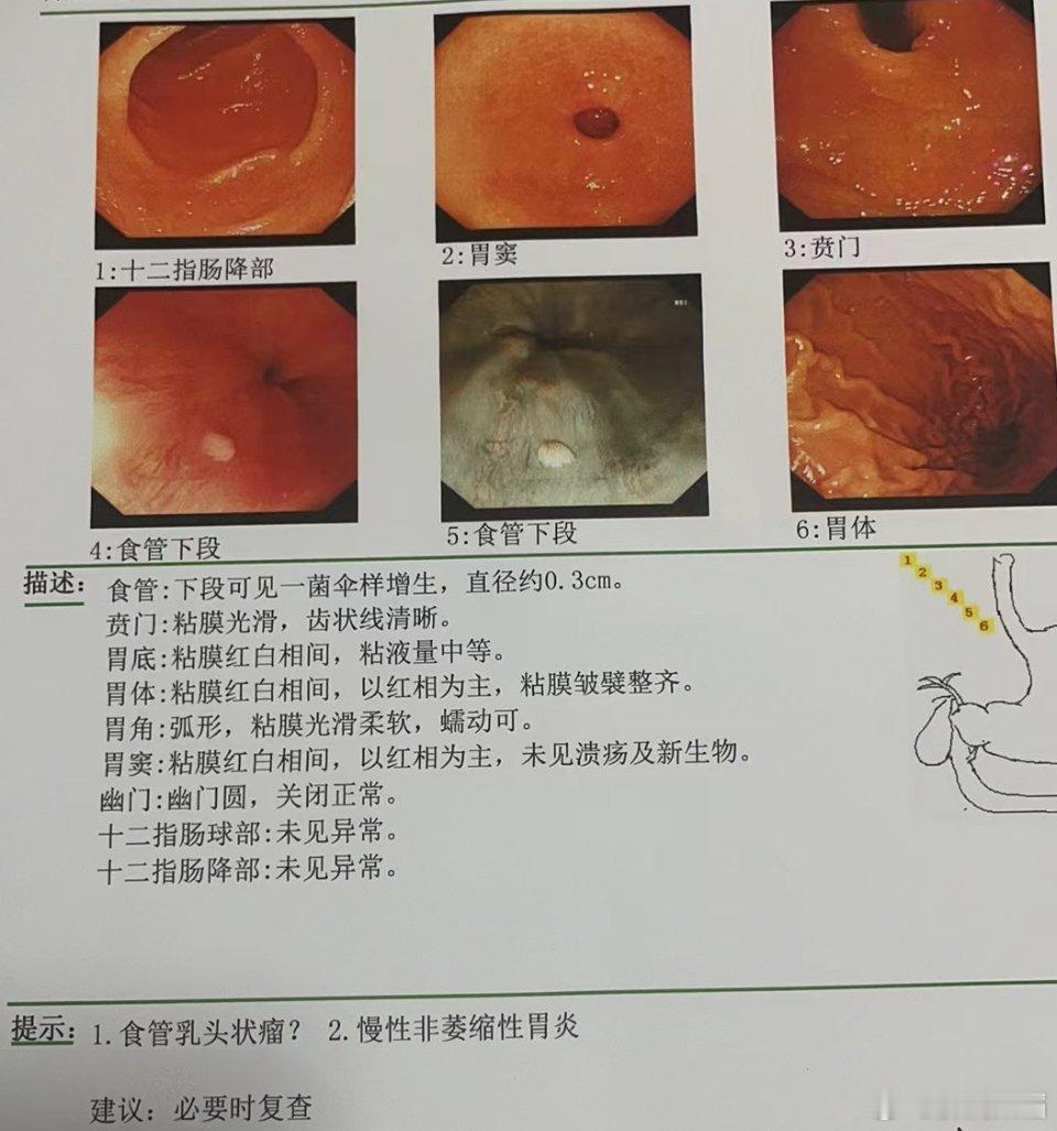 食管乳头状瘤是一种良性肿瘤，通常起源于食管黏膜上皮。 其病因尚不完全明确，可能与