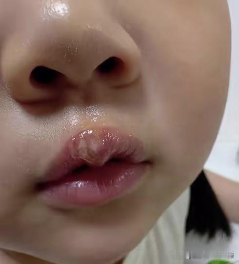 被热熔枪烫伤的嘴唇，叩问童年守护之责
       江苏徐州丰县机关第二幼儿园实