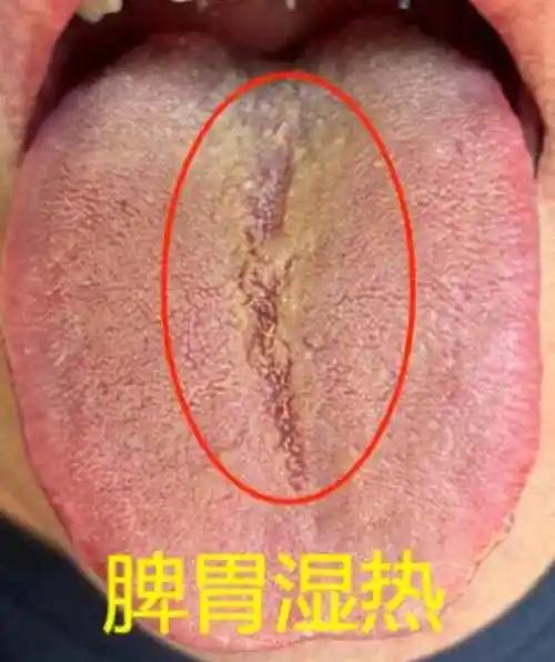 身体被湿热“纠缠”？一文教你精准辨别4种常见湿热——脾胃湿热、肝胆湿热、下焦湿热