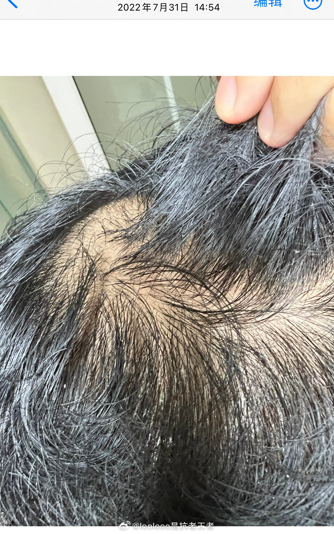 脱发有多可怕？导数据看到我两年前的头发了，真吓人😟 ，难怪我当时都抑郁了。 