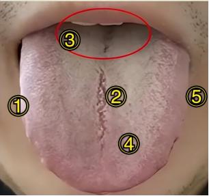 看到舌中裂纹，舌苔黄腻，就以为是脾虚湿热？大错特错！
 
患者情况：消化不良，食