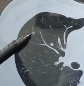 如果连续两年的复查结果显示肺结节没有任何变化，是否还需要继续进行复查呢？#拒绝肺