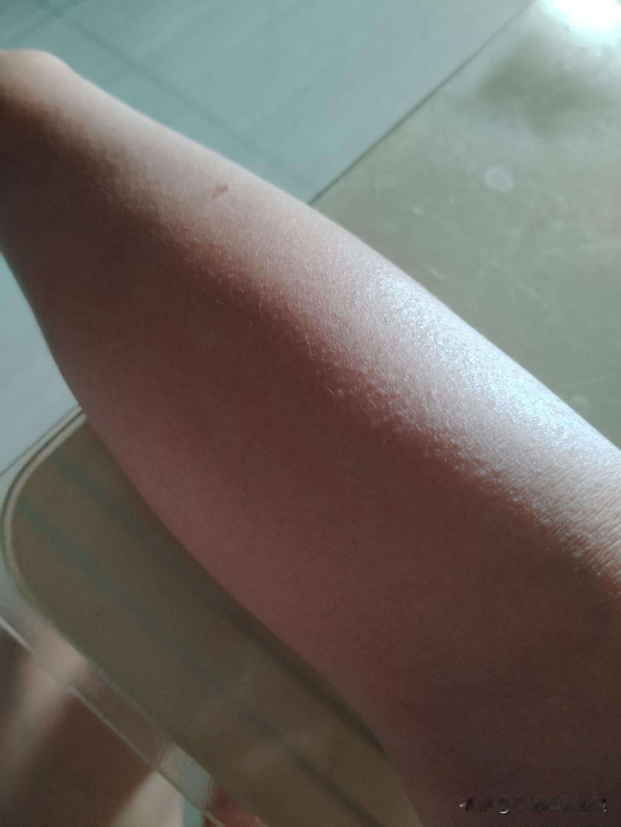 真的是痒得皮肤都抓破了，还是痒，可是医生没给我开药。
今年不知道是怎么了，双手臂