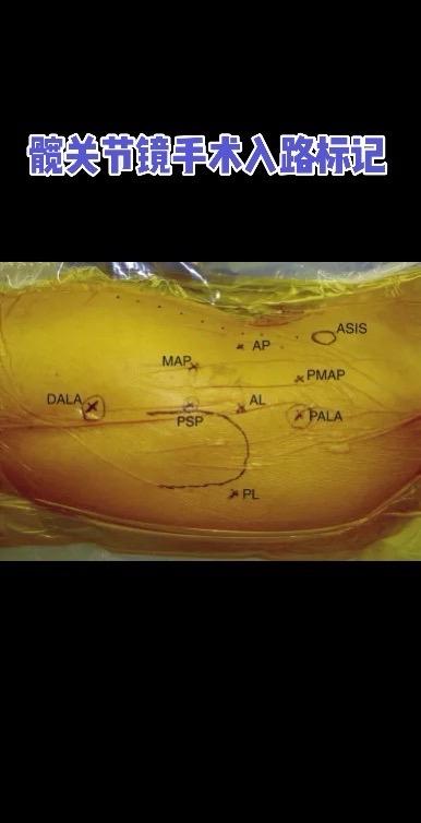 髋关节镜手术入路标识‼️。髋关节镜手术的关键在于精准的入路选择！带你清...
