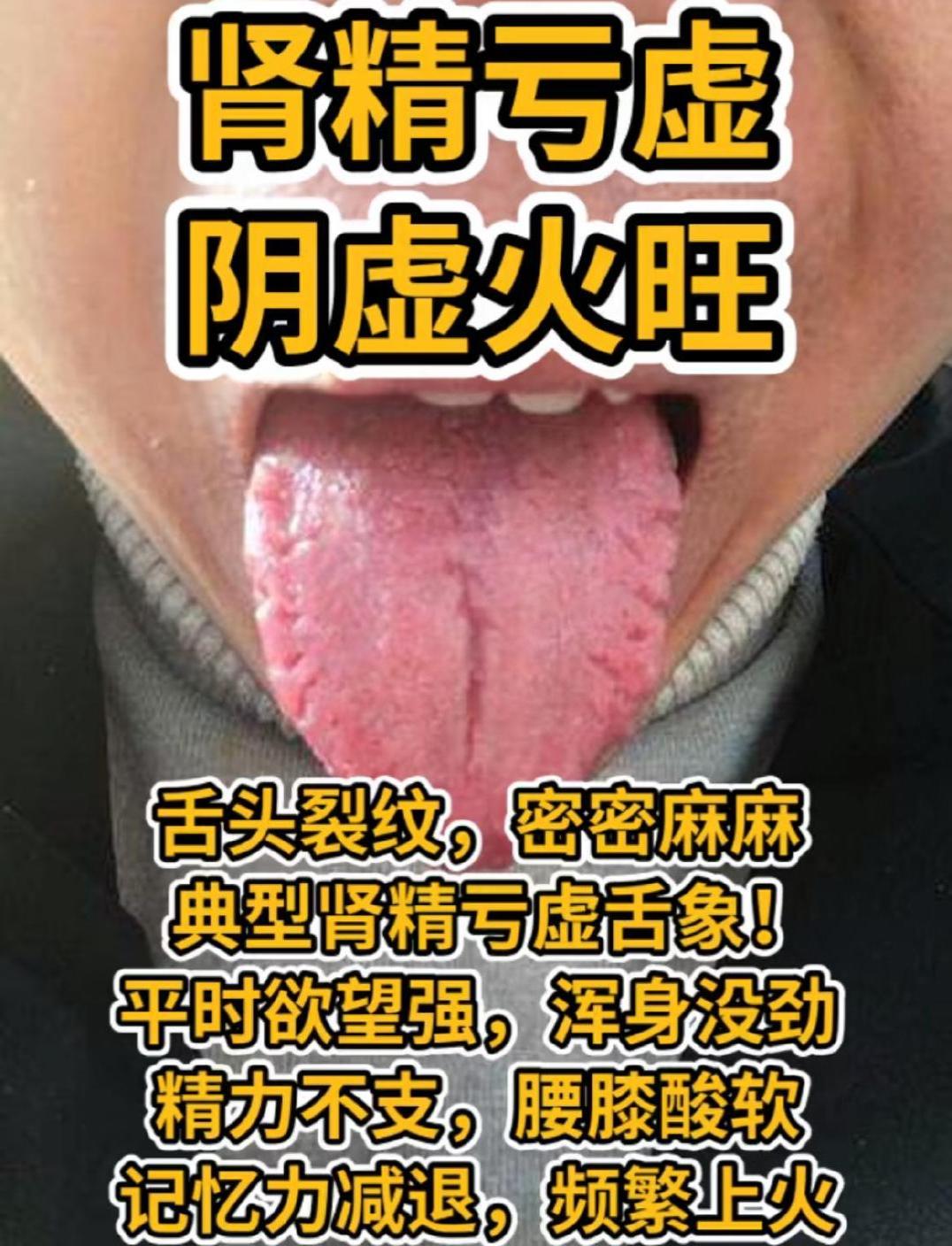 今天继续免费舌诊，你发我就看，需要了解身体健康问题的就来！

再给大家分享一位粉