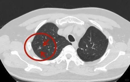 肺结节非肺癌先兆，但变化可不存微！ 我发现很多来访的朋友们，一说到肺部...