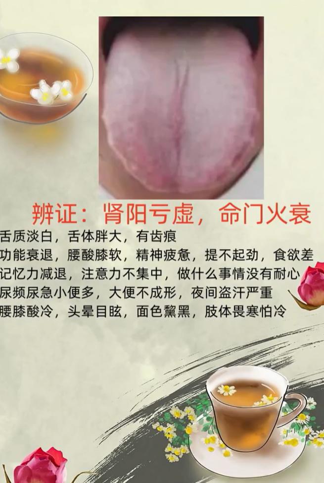 舌胖大有齿痕，多为肾阳不足、命门火衰