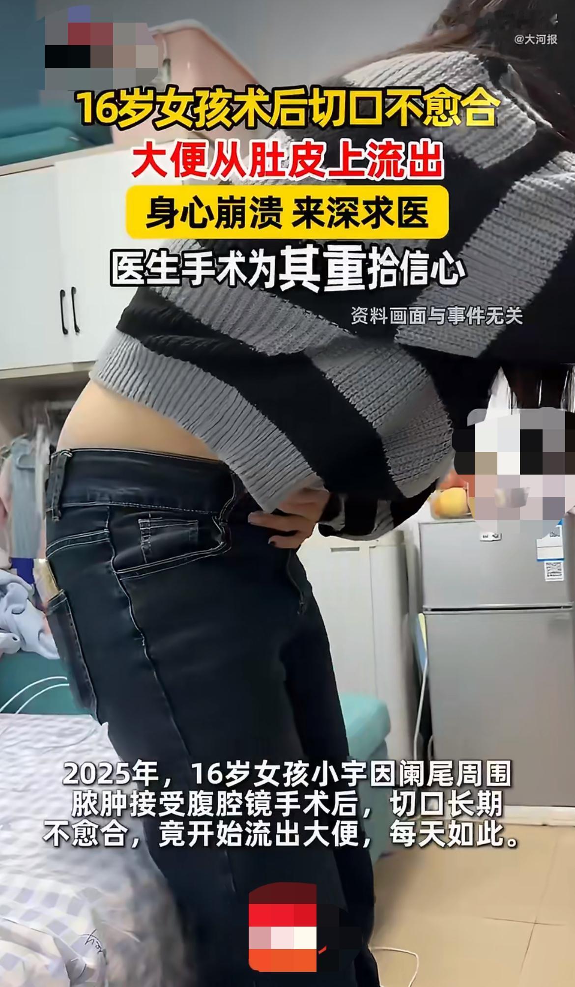 “算是医疗事故吧？”16岁少女小宇阑尾手术后，切口老不好不说，吃下去的东西消化完