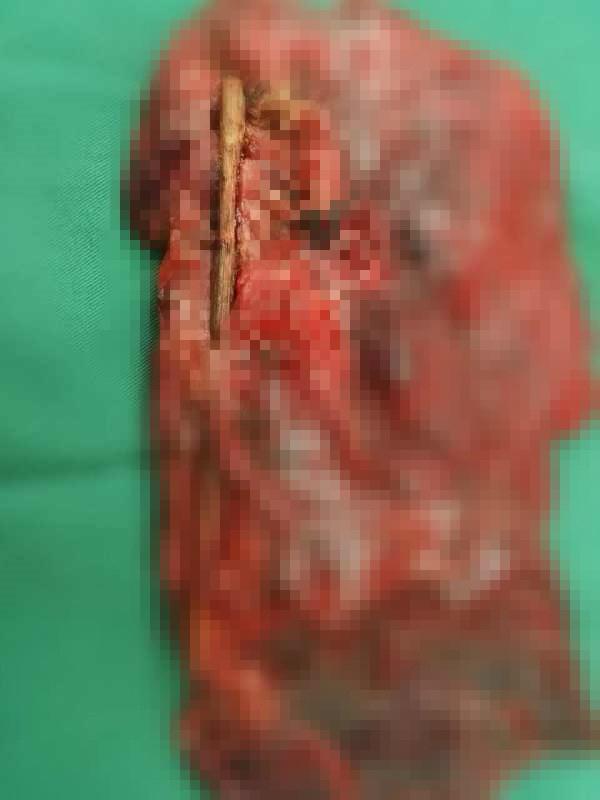 76岁的老张咳嗽咯血一年多，原来是肺部藏了片西瓜子皮。2025年12月，他在漯河