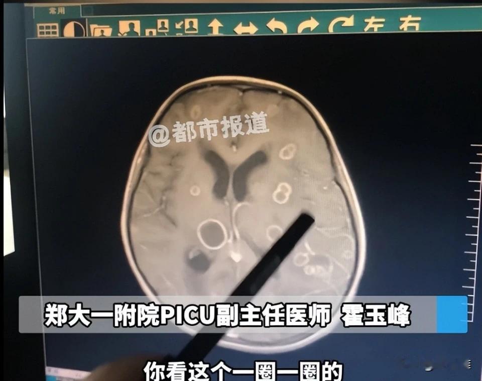 太可怕了，6岁女孩高烧17天意识出现模糊，送医院检查后发现脑袋都被“啃”出几个空