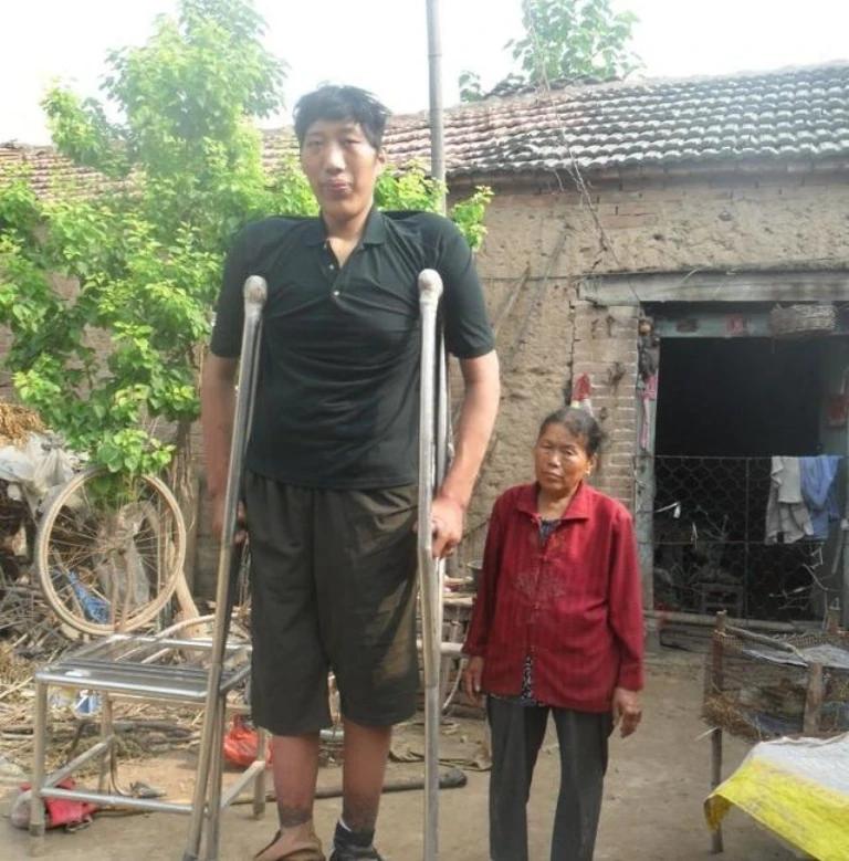 山东“巨人”徐富海离世，2.4米的身躯难抵十多种病痛折磨，幼时更随母亲沿街要饭，