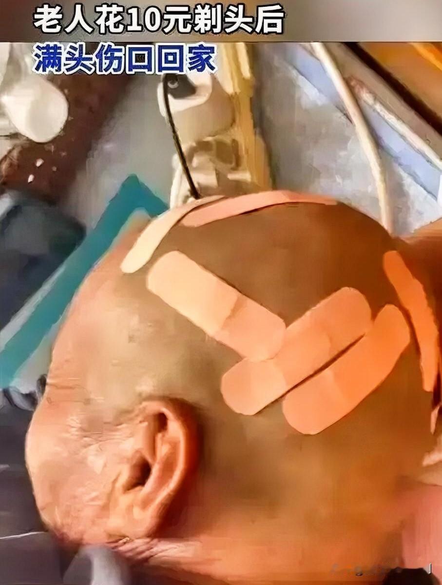 10元剃头变“伤头”，大爷善良不忍追责

一位大爷去街边摊花10元剃头，不料剃完