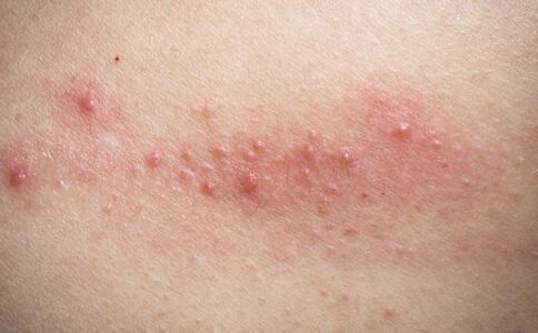 皮肤干痒是很多人常遇到的问题，很多人会觉得和吃东西有关，但实际上，关于饮食和皮肤