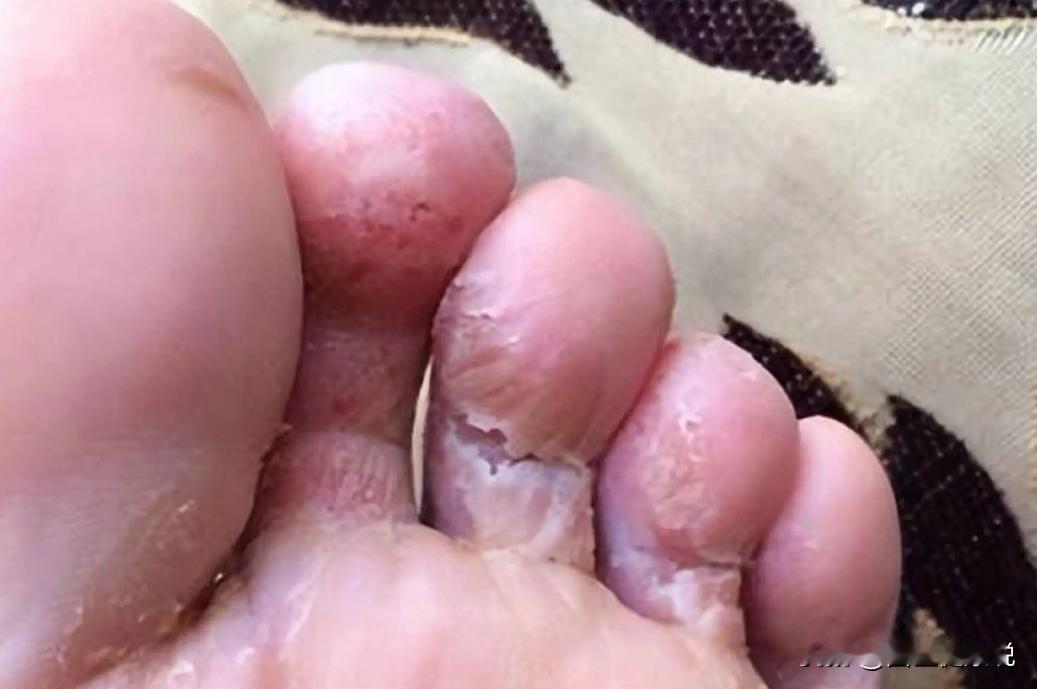 一封来自脚气患者的感谢信
 
“陈医生你好，我是上个月找你看脚气的小王，不知道你