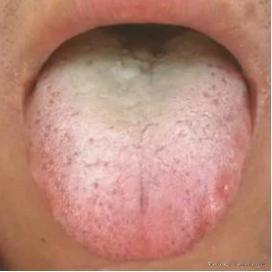 这样的舌头，哪哪都是问题！肝郁、脾虚、痰湿、内热占完了
病人主诉：脾气急，老想发