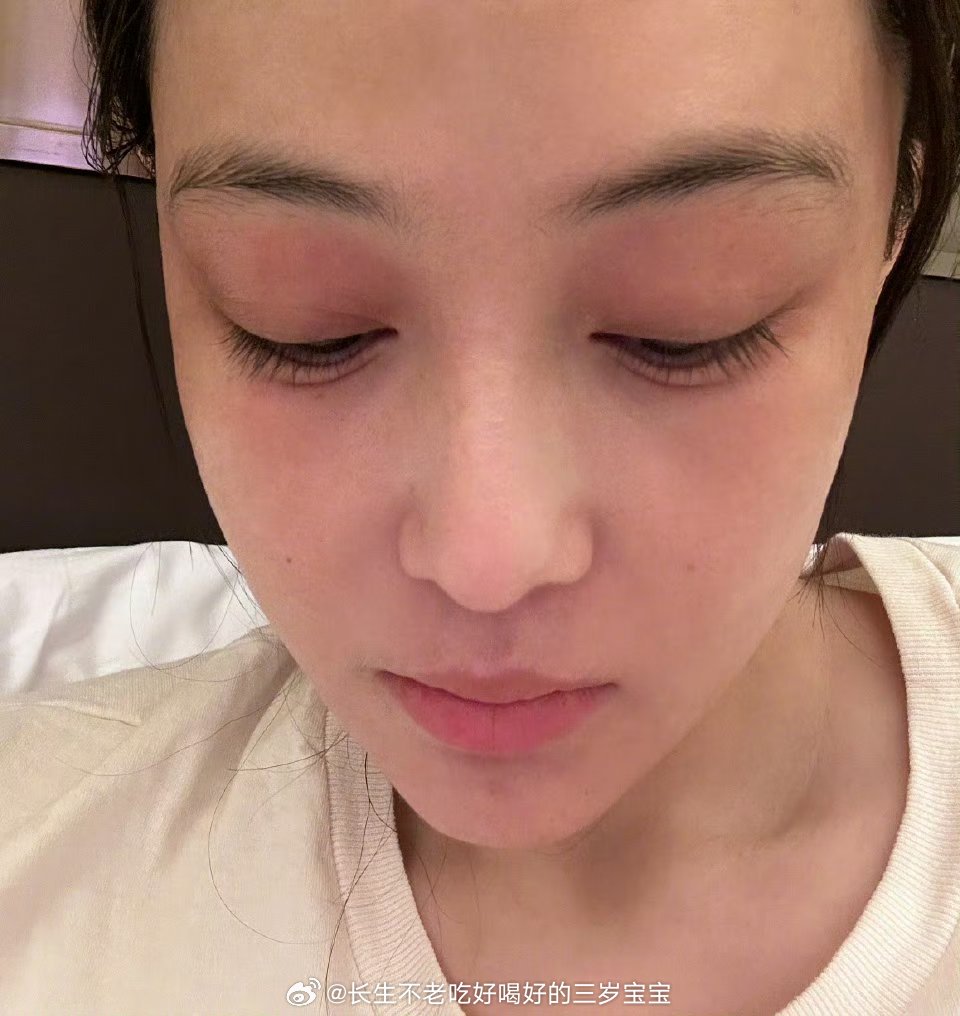 张馨予也被蒸汽眼罩烫伤过天呐！原来张馨予之前也被蒸汽眼罩烫伤过！她之前在零下40