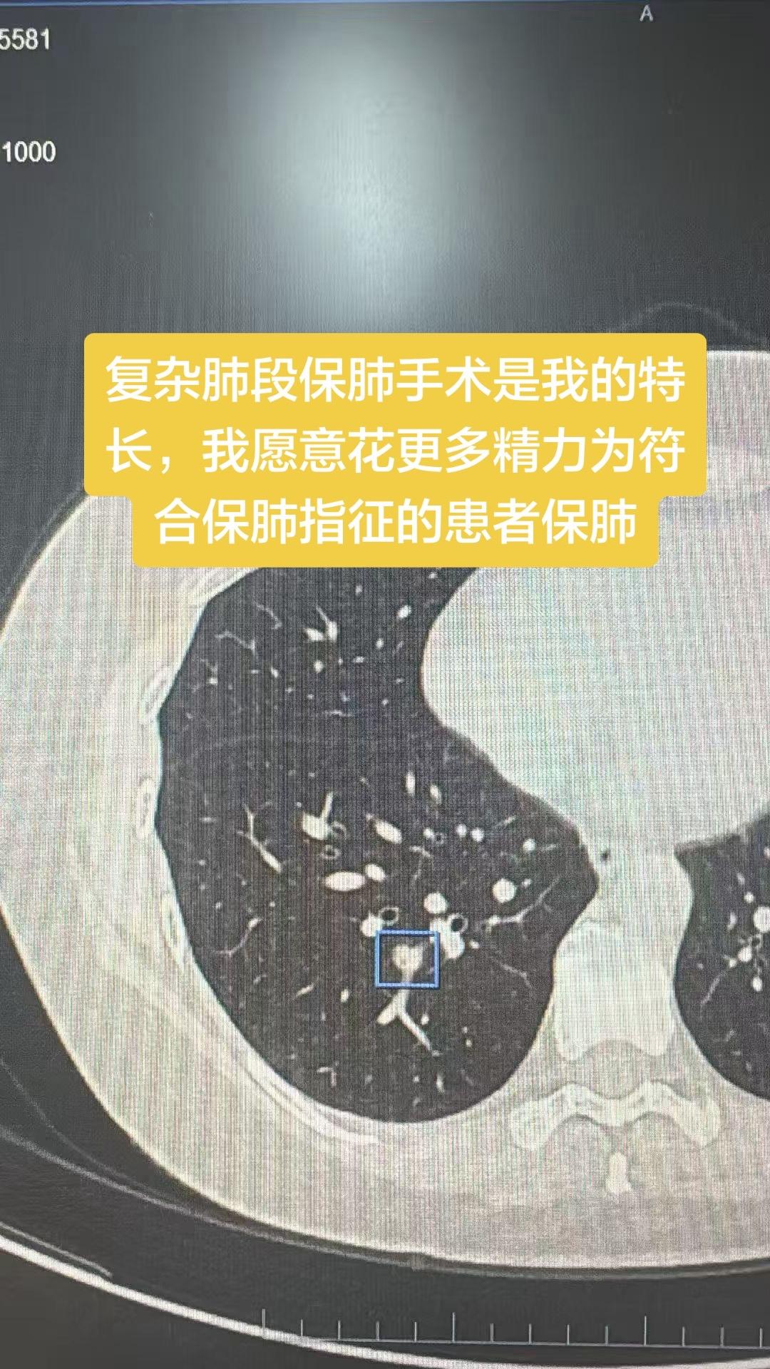 花更多的精力做一些复杂手术保肺 复杂肺段保肺手术是我的特长，我愿意花更...