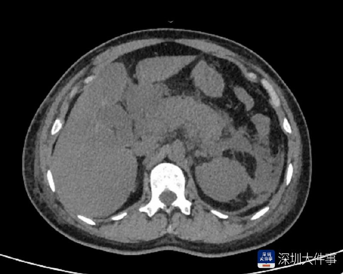 #女子腹痛硬扛10小时确诊胰腺炎#【腹痛误当胃肠炎硬扛10小时，深圳女子确诊急性