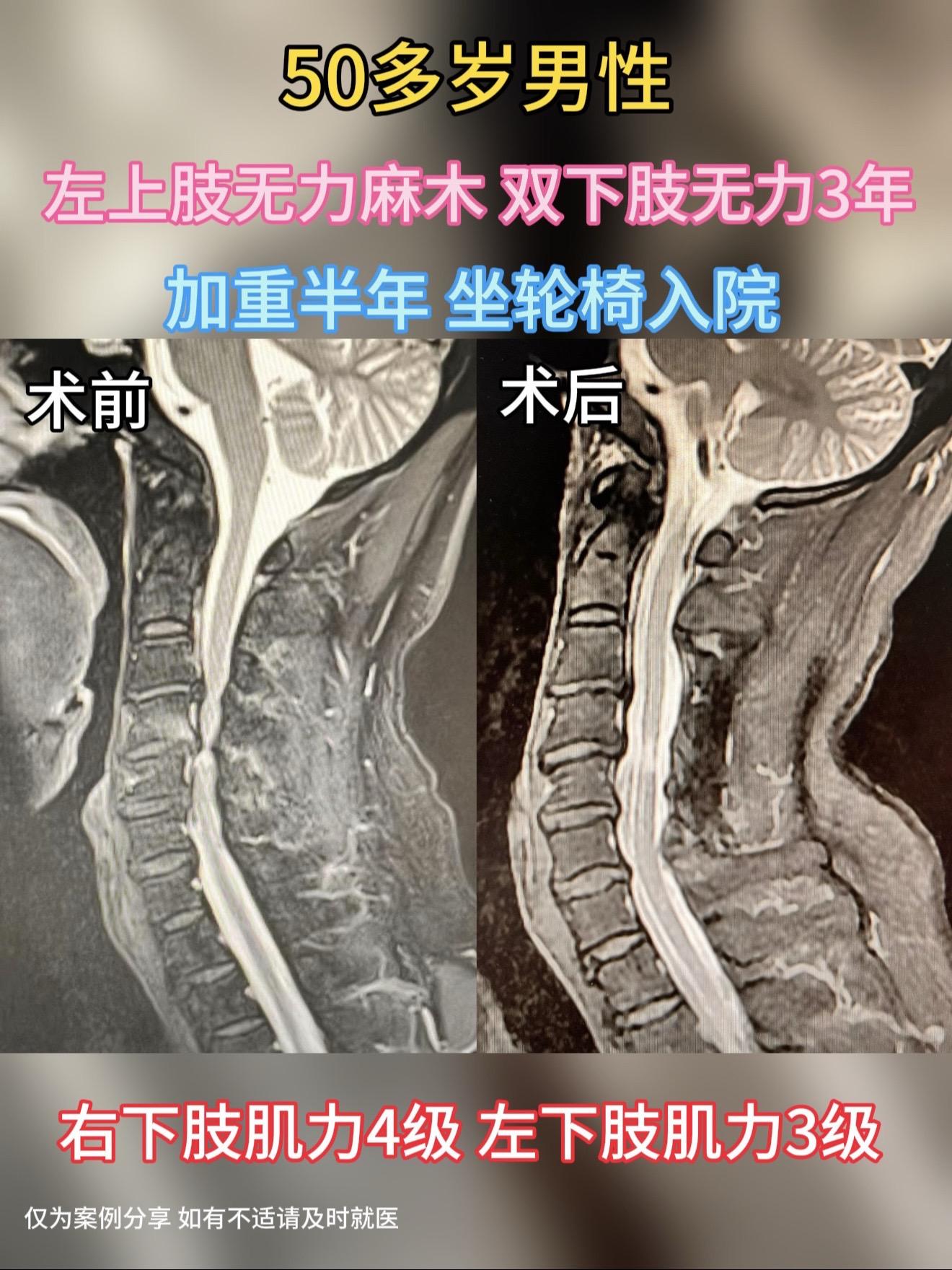 50多岁男性，左上肢无力麻木，双下肢无力3年，加重半年。入院时轮椅推入...